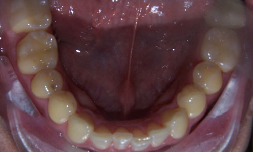 Patient smile before orthodontic treatment (case 41)