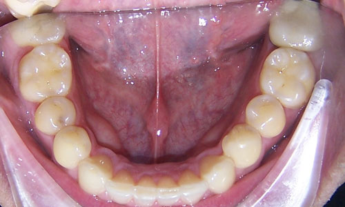 Patient smile after orthodontic treatment (case 41)