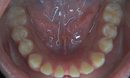 Patient smile before orthodontic treatment (case 33)