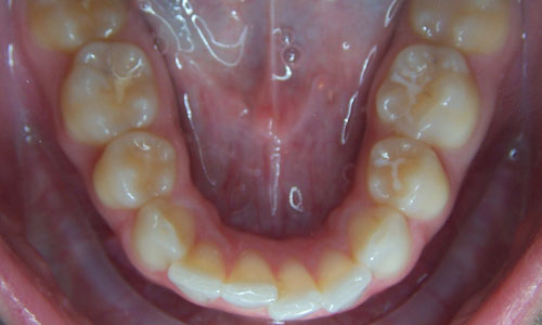 Patient smile before orthodontic treatment (case 42)