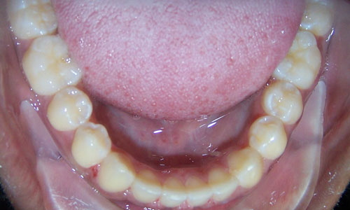 Patient smile after orthodontic treatment (case 33)