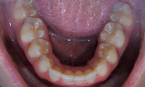 Patient smile after orthodontic treatment (case 42)