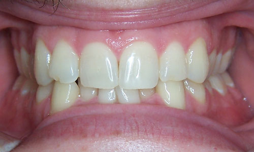 Patient smile before orthodontic treatment (case 2)