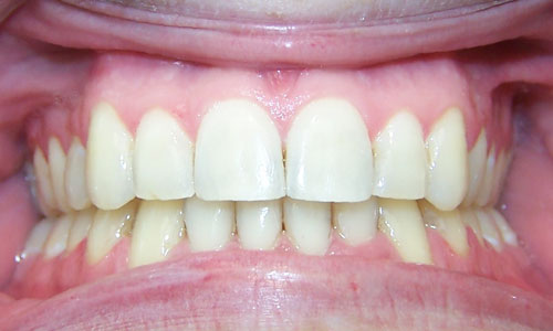 Patient smile after orthodontic treatment (case 2)