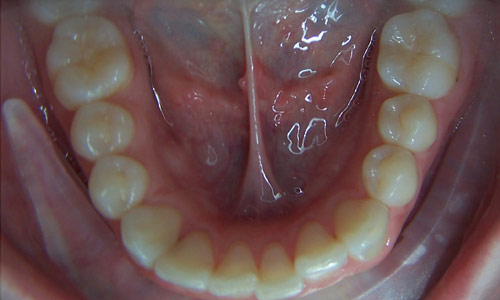 Patient smile before orthodontic treatment (case 43)