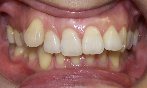 Patient smile before orthodontic treatment (case 3)