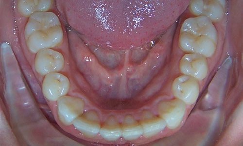 Patient smile after orthodontic treatment (case 43)