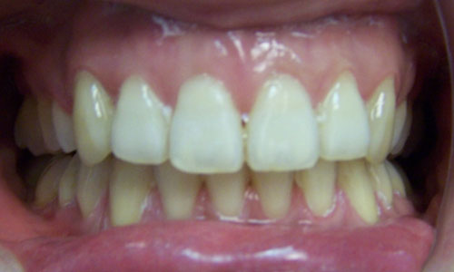 Patient smile after orthodontic treatment (case 3)