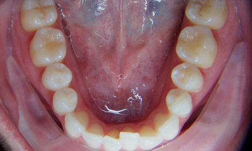 Patient smile before orthodontic treatment (case 44)