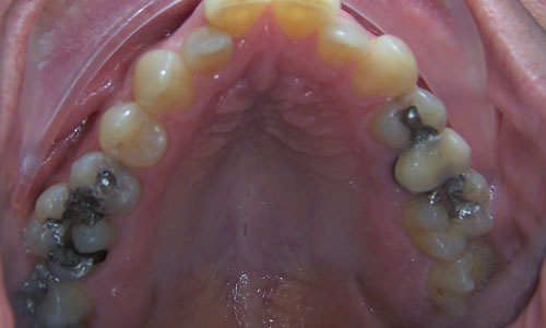Patient smile before orthodontic treatment (case 4)