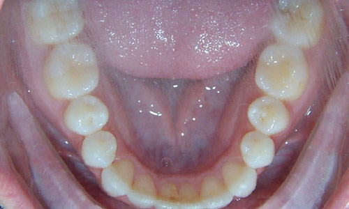 Patient smile after orthodontic treatment (case 44)