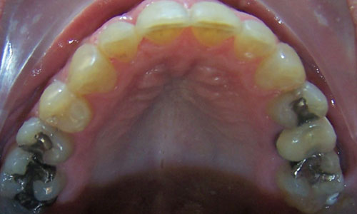 Patient smile after orthodontic treatment (case 4)