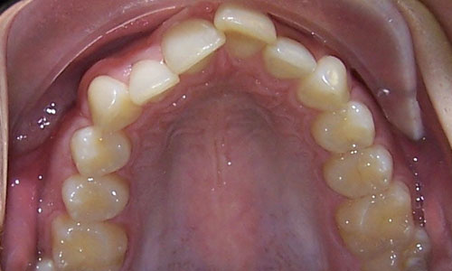 Patient smile before orthodontic treatment (case 5)