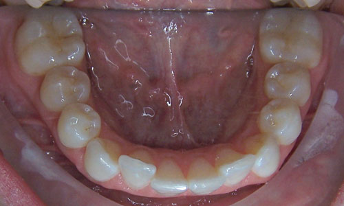 Patient smile before orthodontic treatment (case 45)
