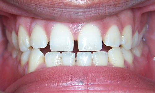 Patient smile before orthodontic treatment (case 34)