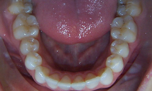 Patient smile after orthodontic treatment (case 45)