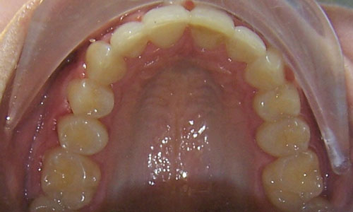 Patient smile after orthodontic treatment (case 5)