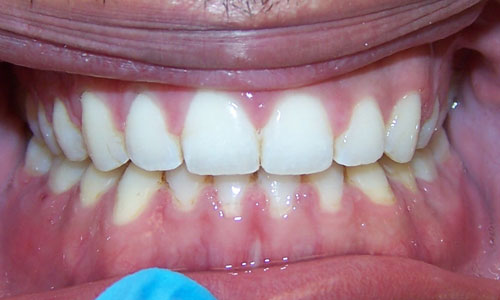 Patient smile after orthodontic treatment (case 34)