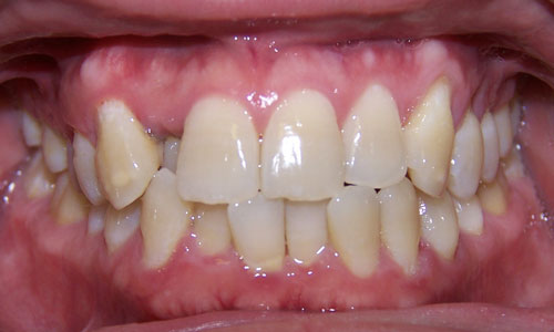 Patient smile before orthodontic treatment (case 6)