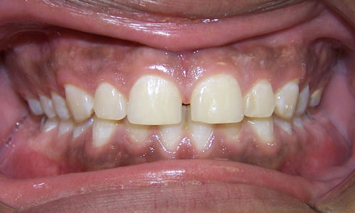 Patient smile before orthodontic treatment (case 46)