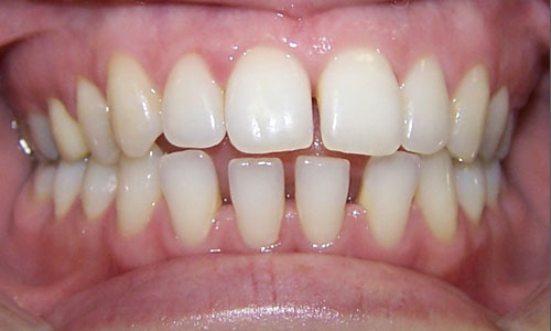 Patient smile before orthodontic treatment (case 35)