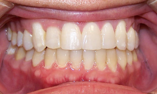 Patient smile after orthodontic treatment (case 6)