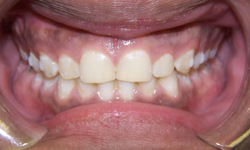 Patient smile after orthodontic treatment (case 46)