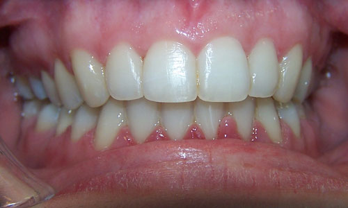 Patient smile after orthodontic treatment (case 35)