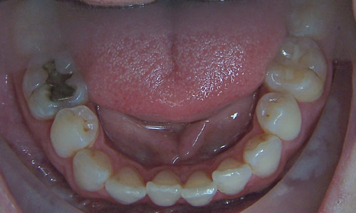 Patient smile before orthodontic treatment (case 47)