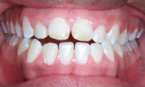 Patient smile before orthodontic treatment (case 7)