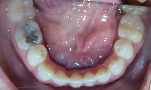 Patient smile after orthodontic treatment (case 47)
