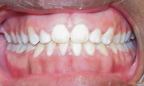 Patient smile after orthodontic treatment (case 7)