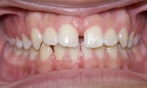 Patient smile before orthodontic treatment (case 8)