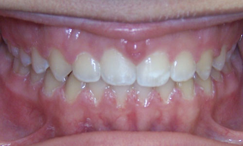 Patient smile after orthodontic treatment (case 8)