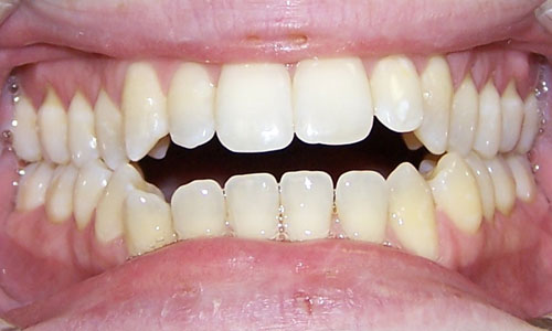 Patient smile before orthodontic treatment (case 9)