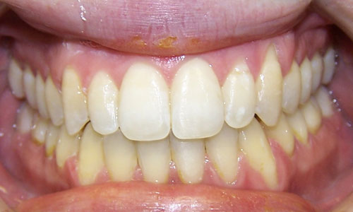 Patient smile after orthodontic treatment (case 9)