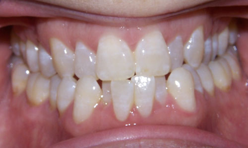 Patient smile before orthodontic treatment (case 10)