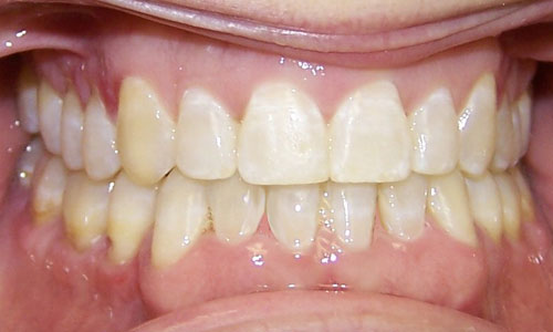 Patient smile after orthodontic treatment (case 10)