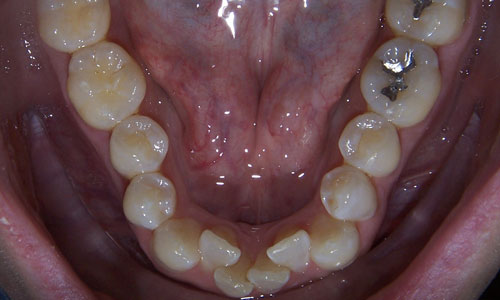Patient smile before orthodontic treatment (case 11)