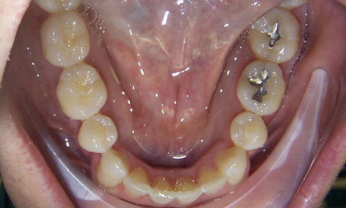 Patient smile after orthodontic treatment (case 11)