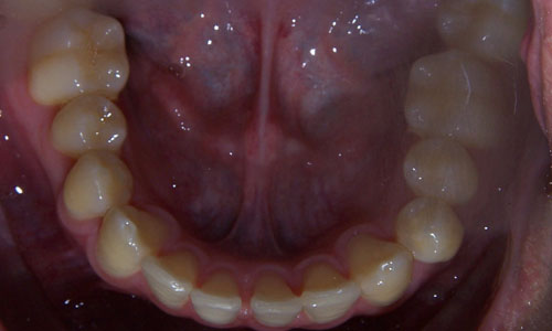 Patient smile before orthodontic treatment (case 48)
