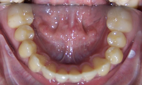 Patient smile after orthodontic treatment (case 48)