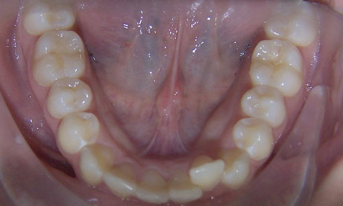 Patient smile before orthodontic treatment (case 49)