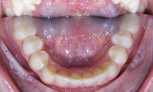 Patient smile after orthodontic treatment (case 49)