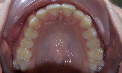 Patient smile before orthodontic treatment (case 50)