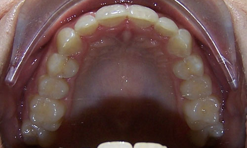 Patient smile after orthodontic treatment (case 50)