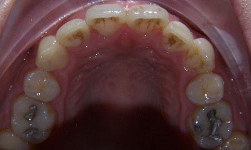 Patient smile before orthodontic treatment (case 51)
