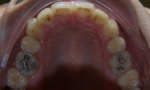 Patient smile after orthodontic treatment (case 51)