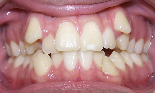 Patient smile before orthodontic treatment (case 12)