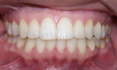 Patient smile after orthodontic treatment (case 12)